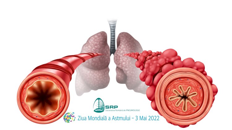 Astmul bronșic, o provocare pentru orice sistem de sănătate 